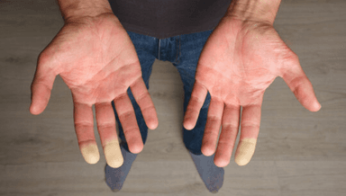 Image for Raynaud's Syndrome